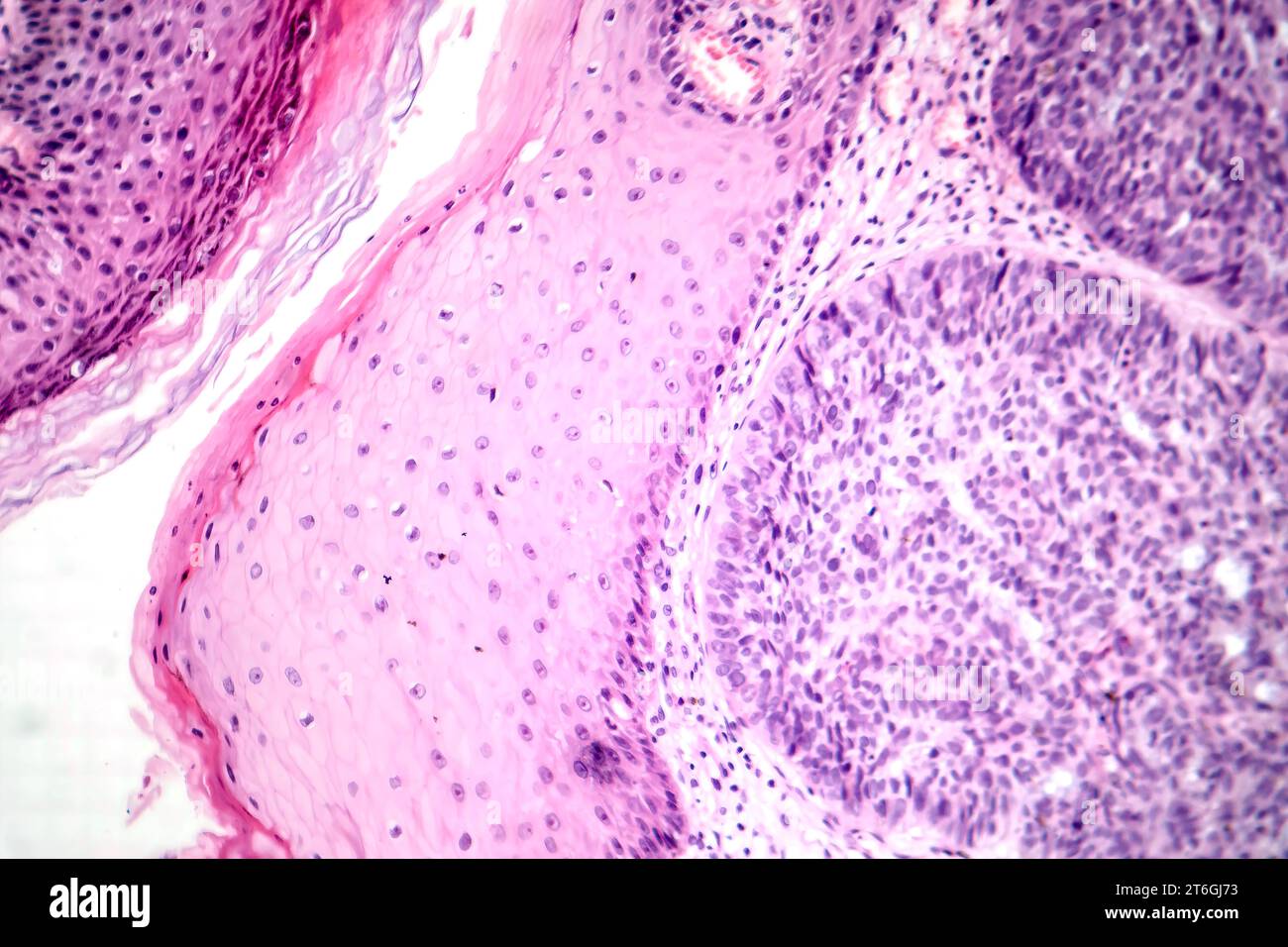 Photomicrograph of basal cell carcinoma, displaying malignant basal