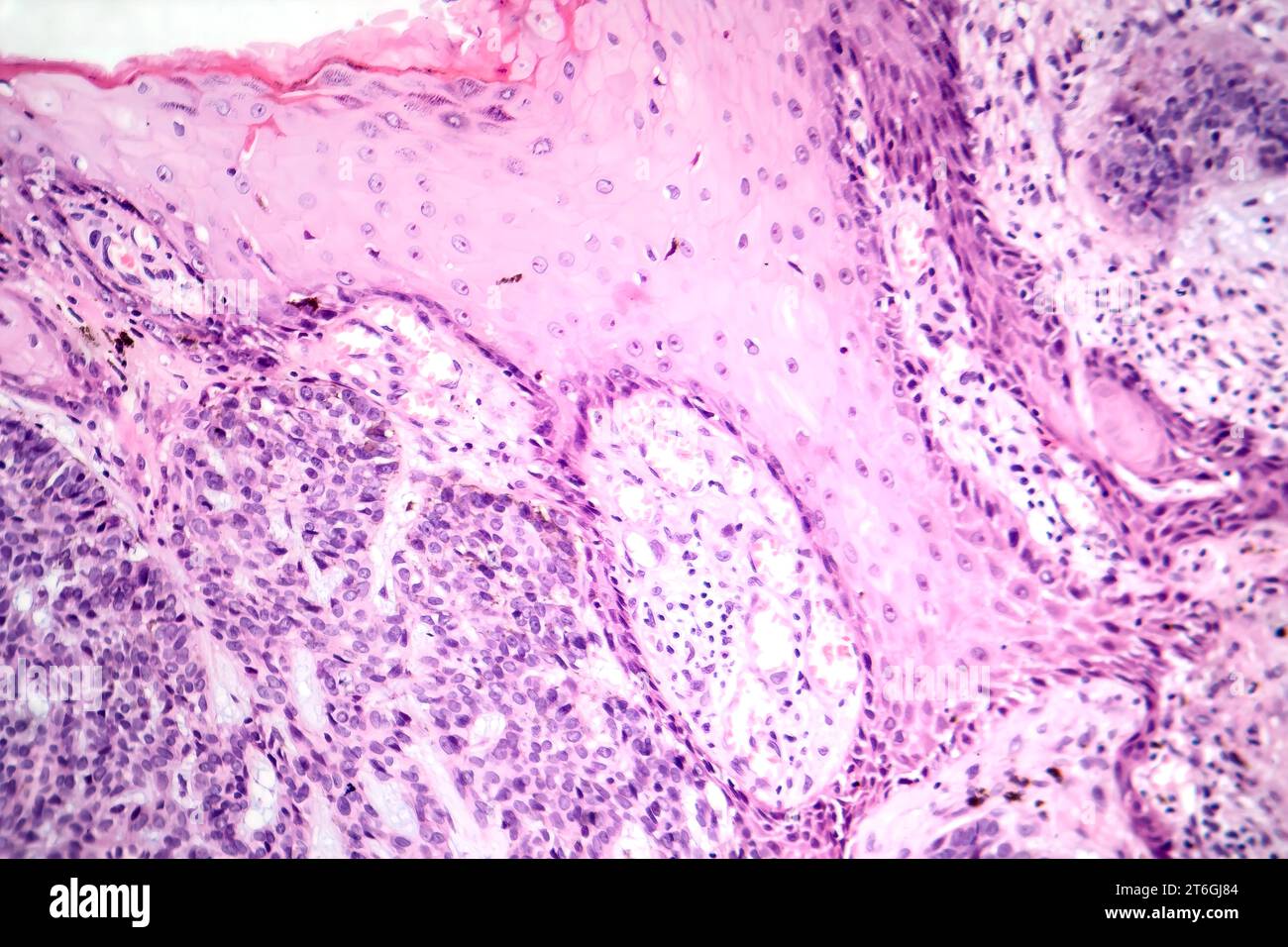 Photomicrograph of basal cell carcinoma, displaying malignant basal