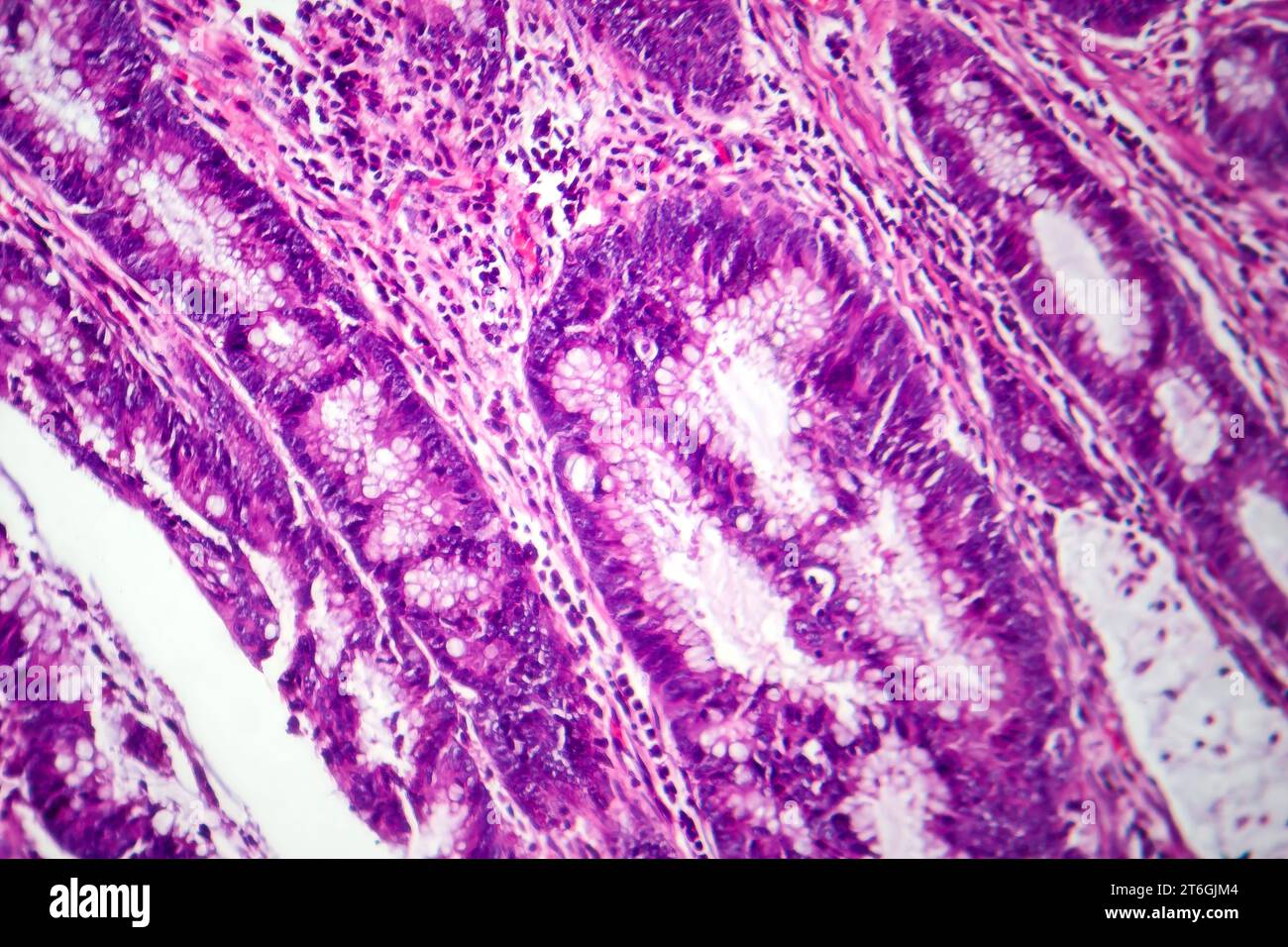 Photomicrograph of colon adenocarcinoma, illustrating malignant glandular cells characteristic of colon cancer. Stock Photo