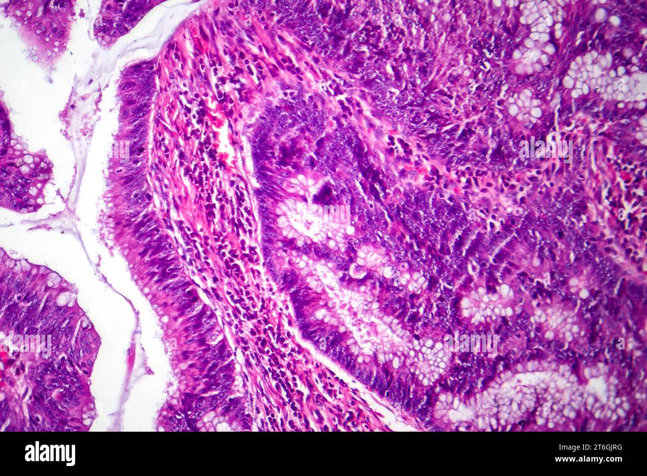 Photomicrograph of colon adenocarcinoma, illustrating malignant
