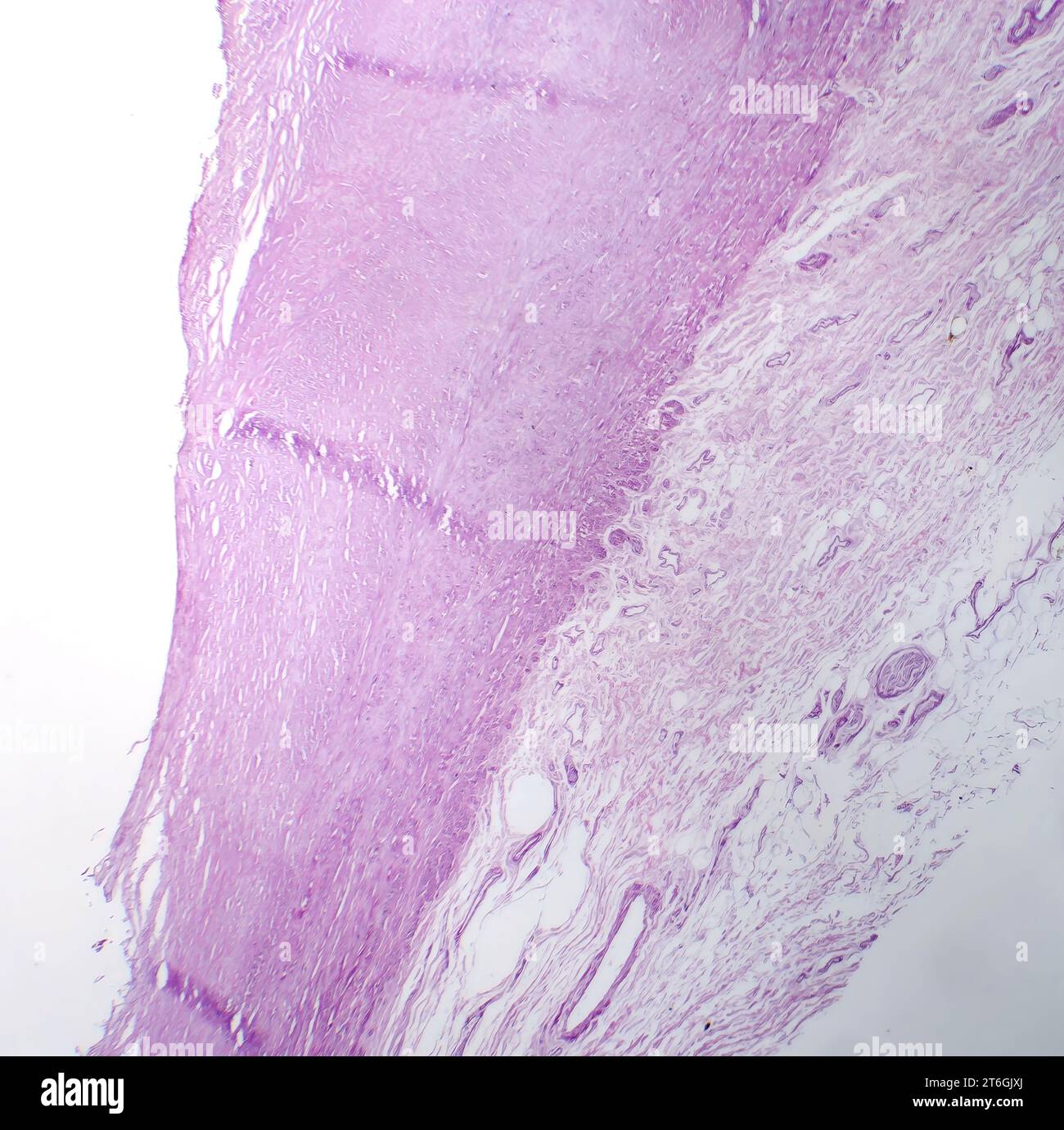 Photomicrograph of aortic atherosclerosis, revealing plaque buildup and narrowing of the aorta