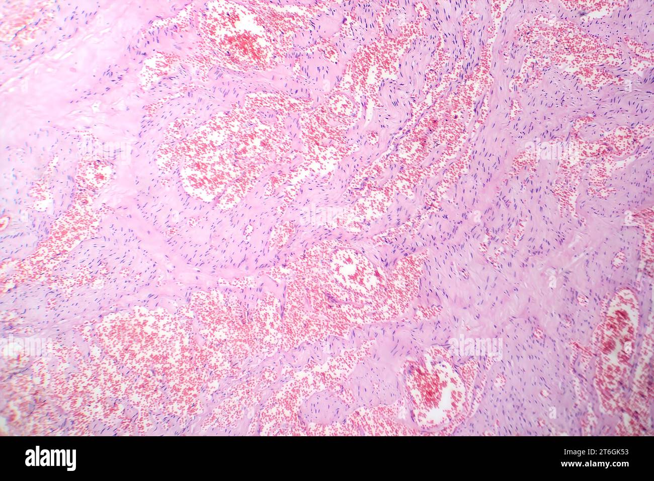 Photomicrograph of capillary hemangioma, illustrating abnormal