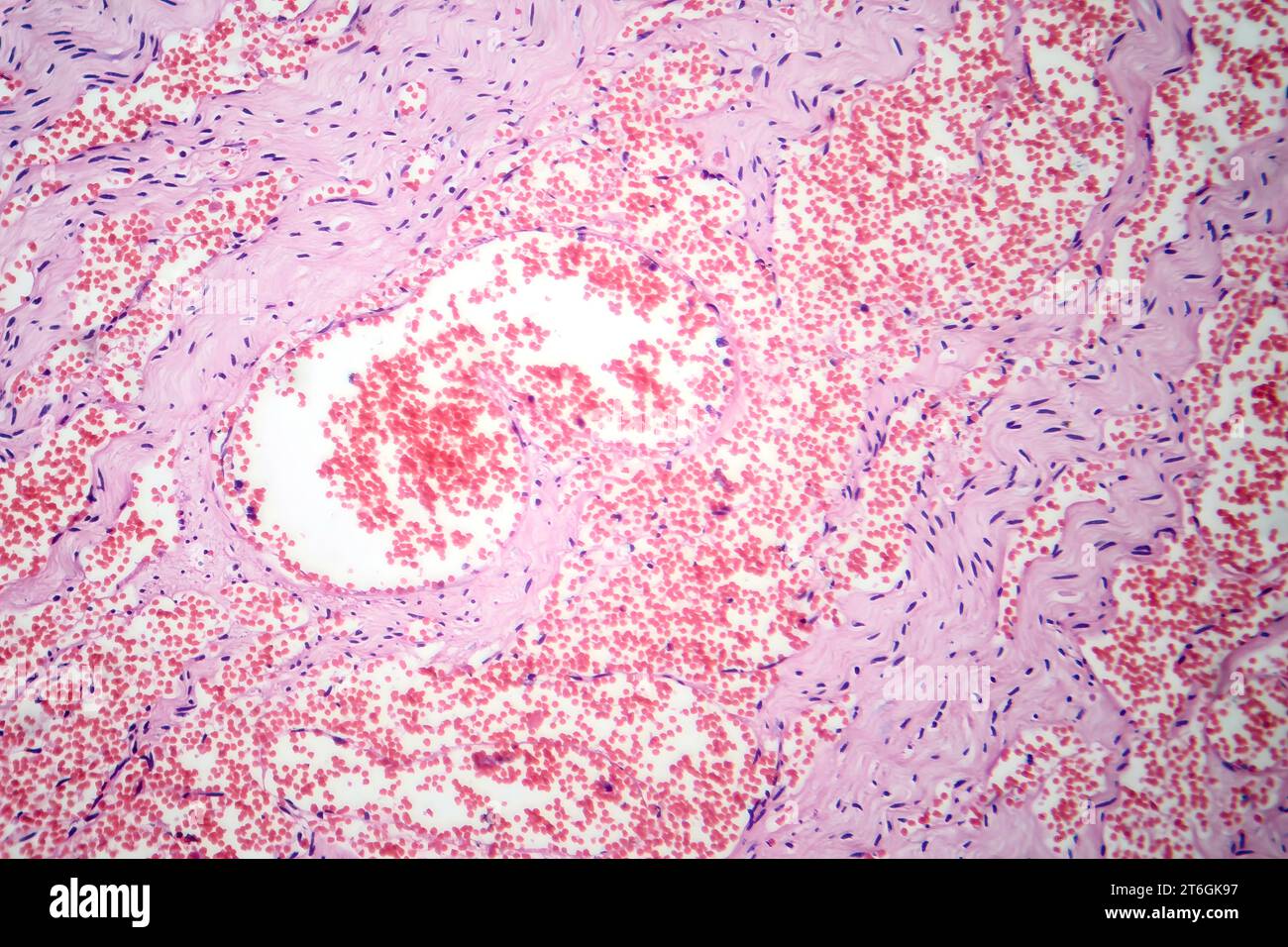 Photomicrograph of capillary hemangioma, illustrating abnormal