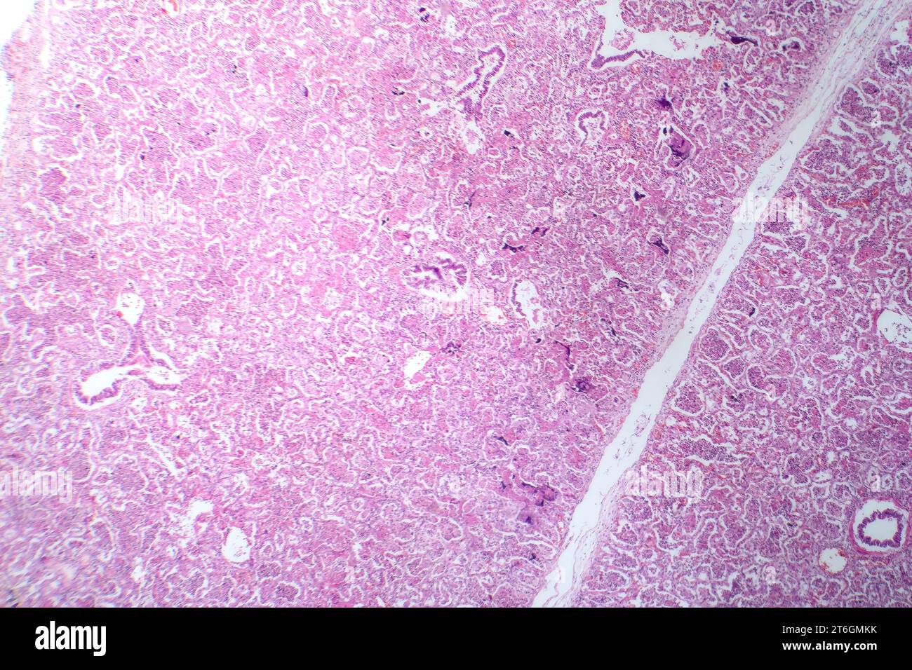 Photomicrograph of lobar pneumonia in red hepatic phase, displaying