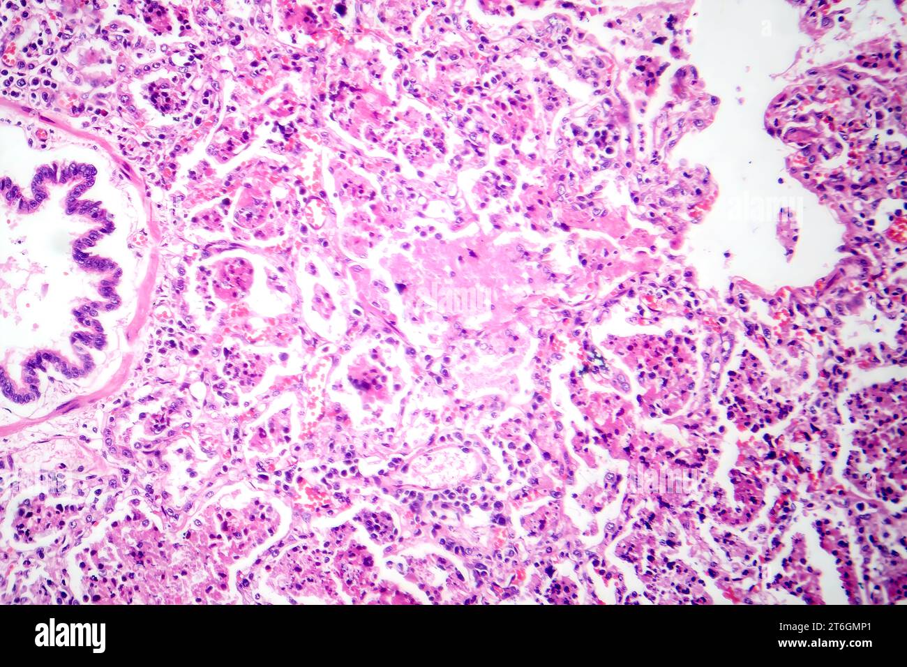 Photomicrograph of lobar pneumonia in red hepatic phase, displaying