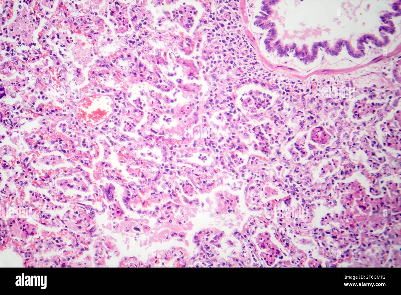 Photomicrograph of lobar pneumonia in red hepatic phase, displaying