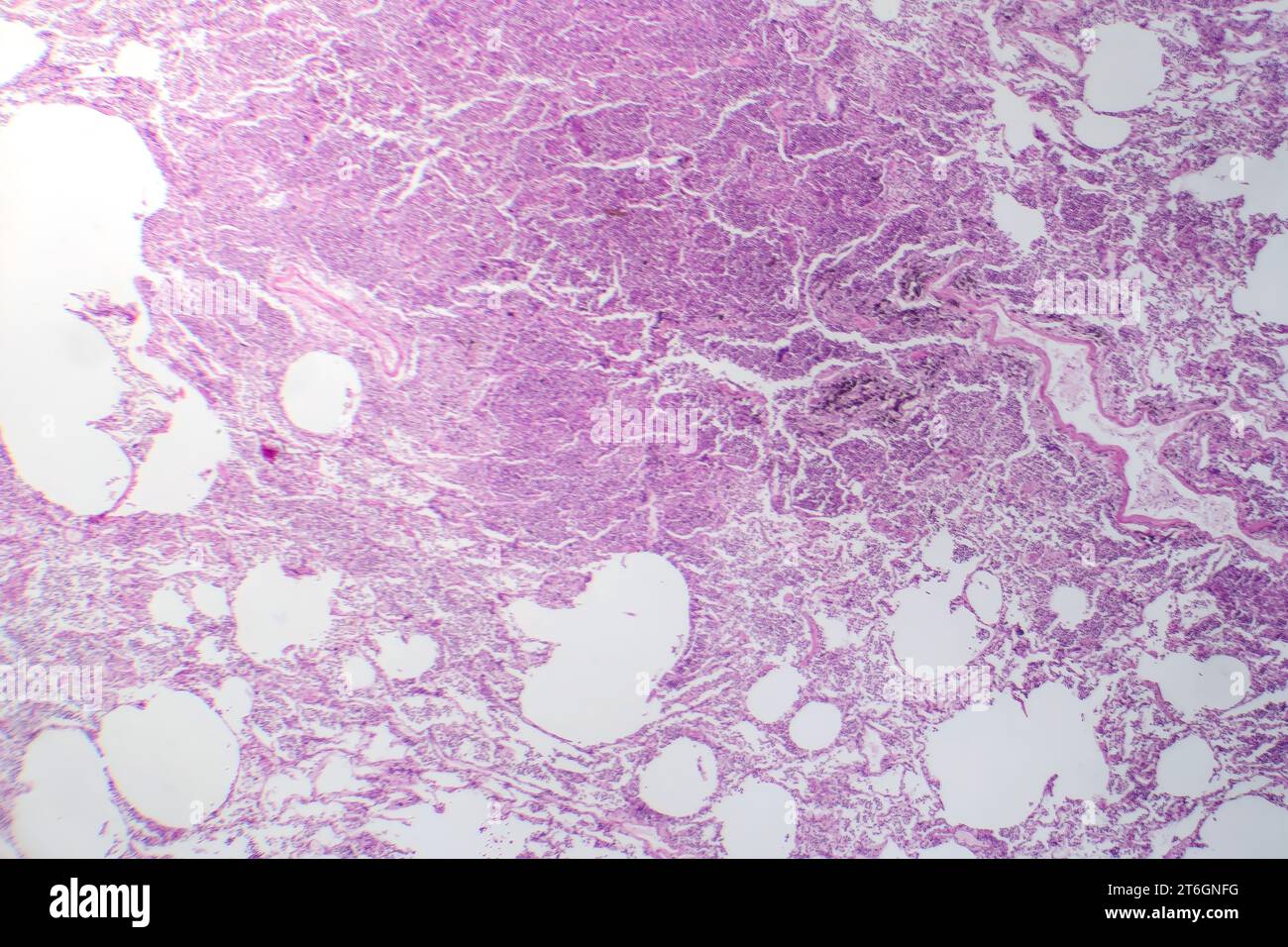 Photomicrograph of interstitial pneumonia, showing inflammation and fibrosis in the lung's interstitial tissue. Stock Photo