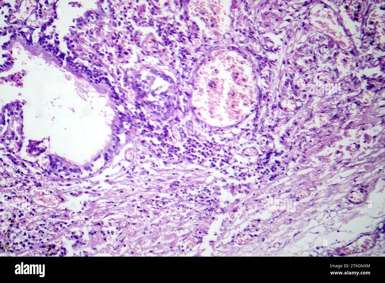 Photomicrograph of viral pneumonia, revealing inflammation and cellular damage caused by a viral respiratory infection. Stock Photo