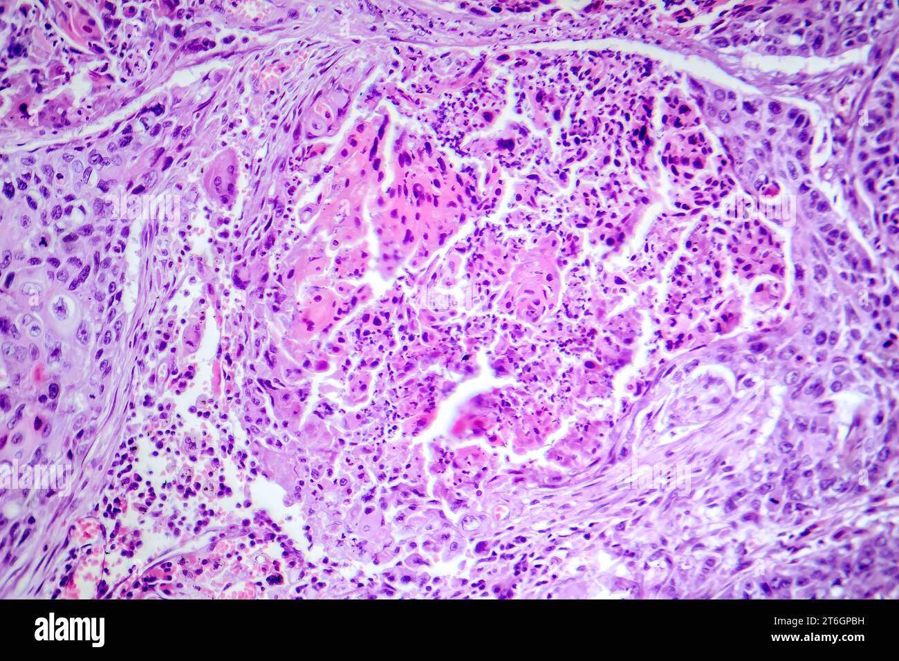 Photomicrograph of squamous cell carcinoma of the lung, showing ...