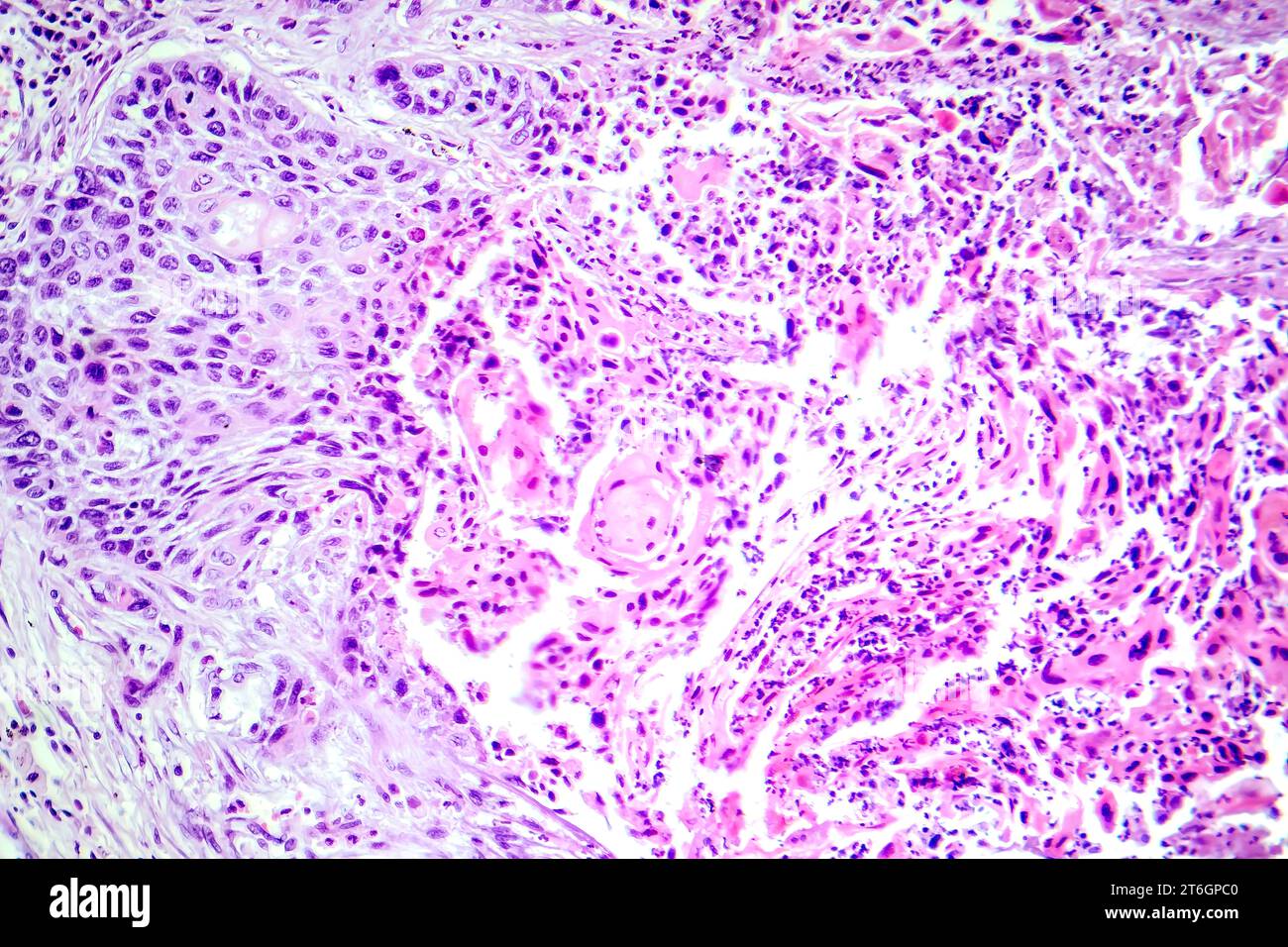 Photomicrograph of squamous cell carcinoma of the lung, showing ...