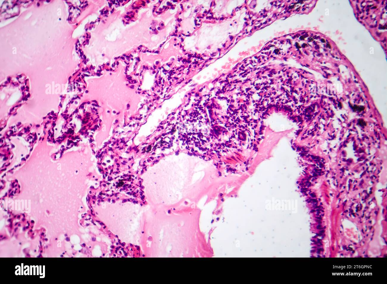 Photomicrograph of lung adenocarcinoma, displaying malignant glandular