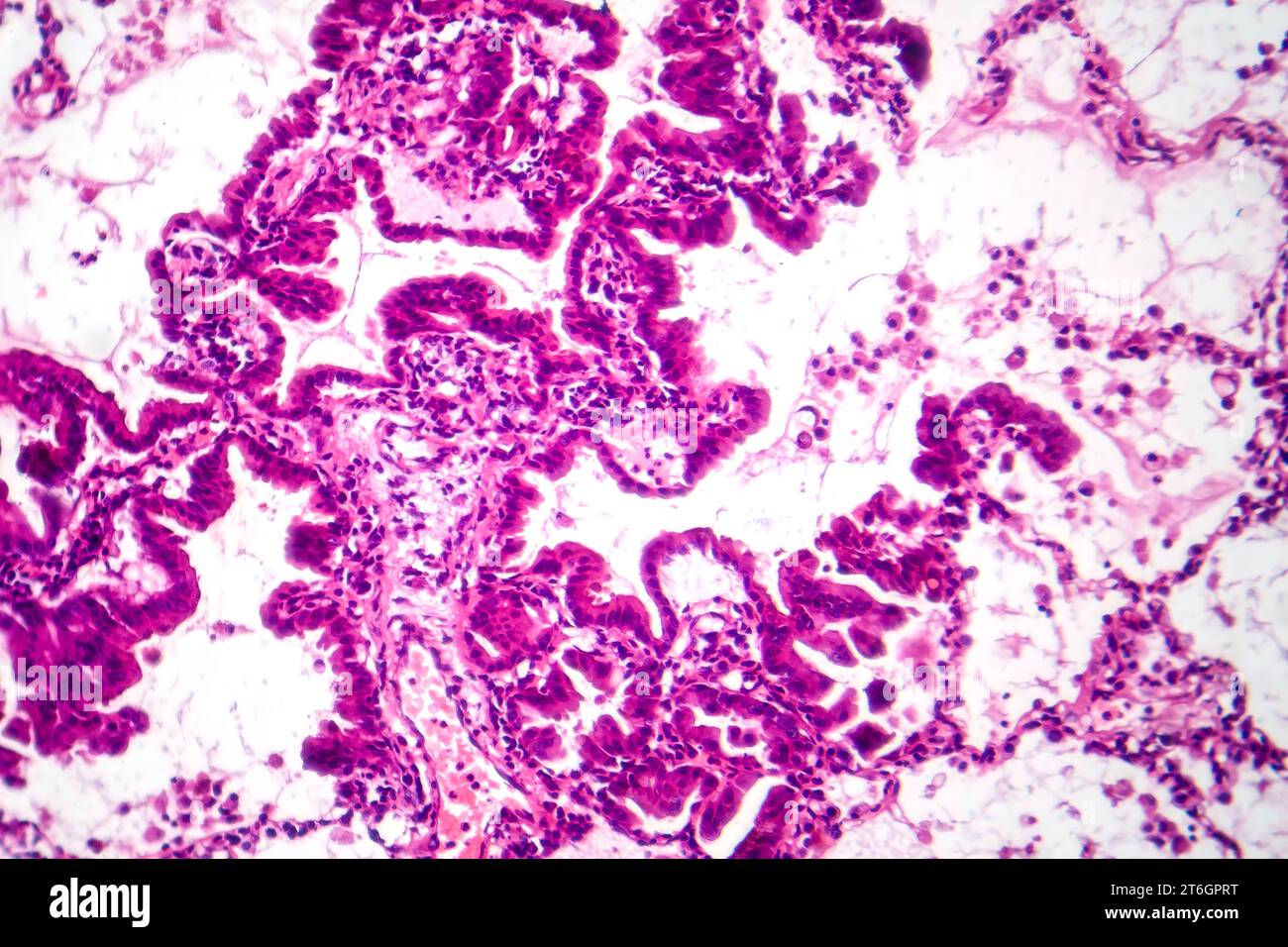 Photomicrograph of lung adenocarcinoma, displaying malignant glandular