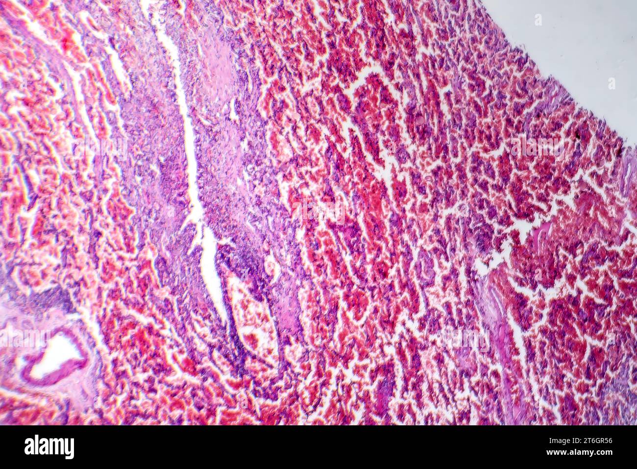Photomicrograph of acute pulmonary hemorrhage, showing bloodfilled