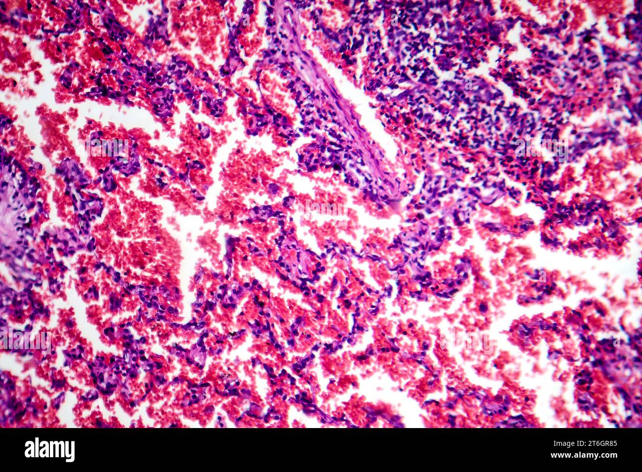 Photomicrograph of acute pulmonary hemorrhage, showing bloodfilled