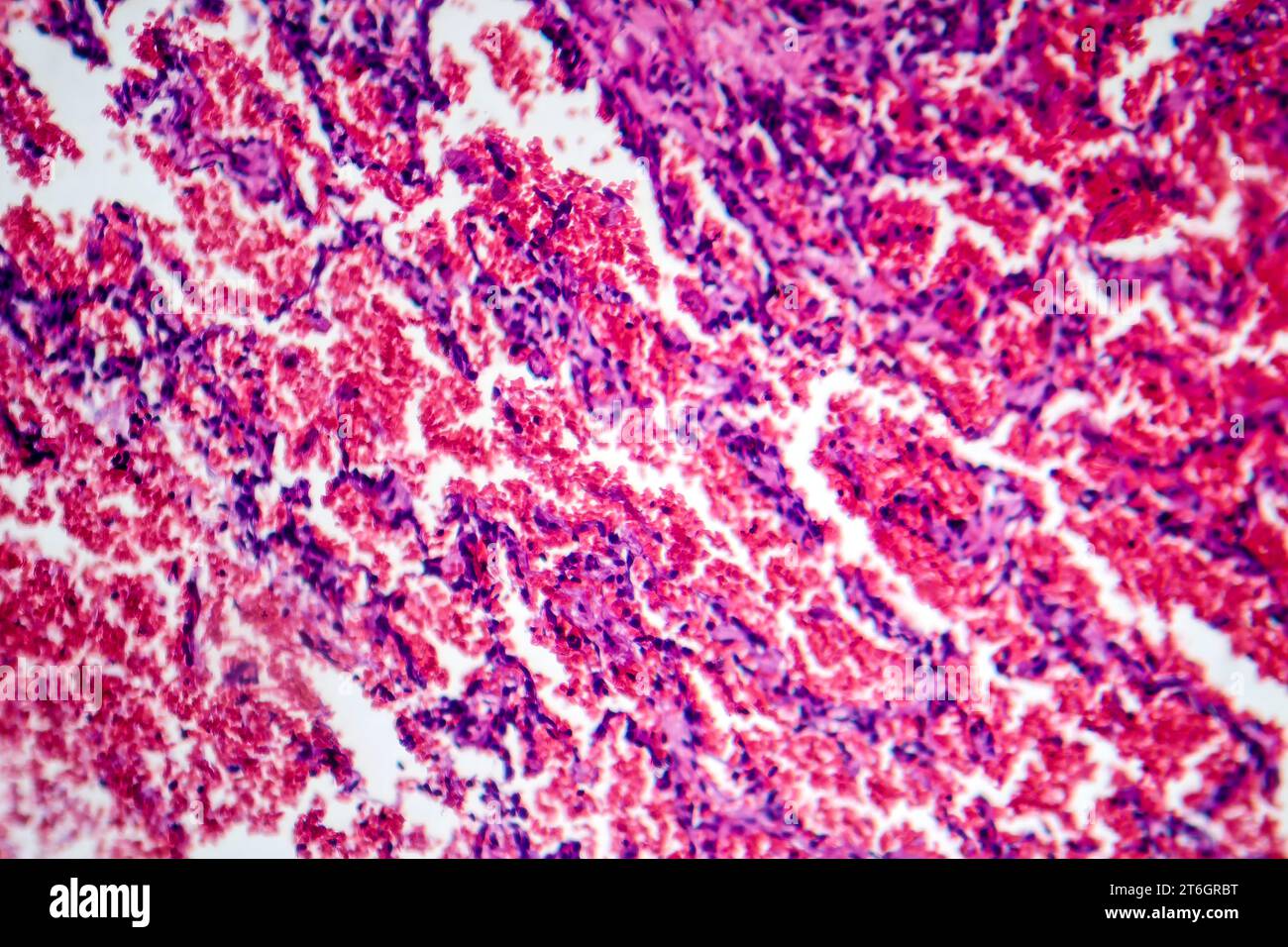 Photomicrograph of acute pulmonary hemorrhage, showing bloodfilled