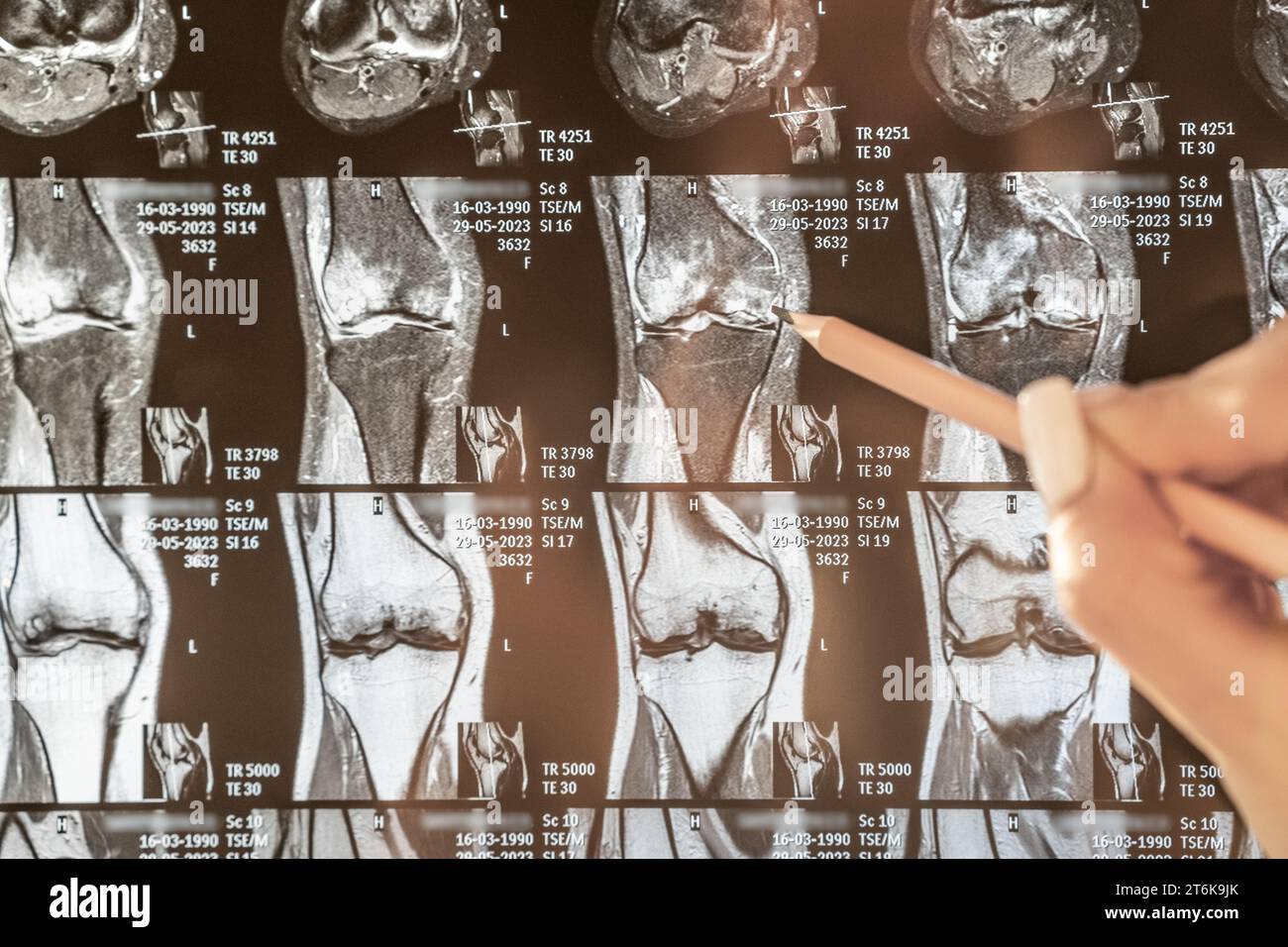 Magnetic resonance imaging of human knee joint for medical diagnosis ...