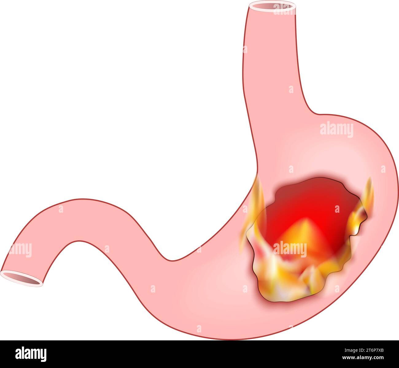 Heartburn. Human stomach with flame. Pyrosis, cardialgia or acid indigestion. burning sensation in the stomach. Gastroesophageal reflux disease GERD. Stock Vector
