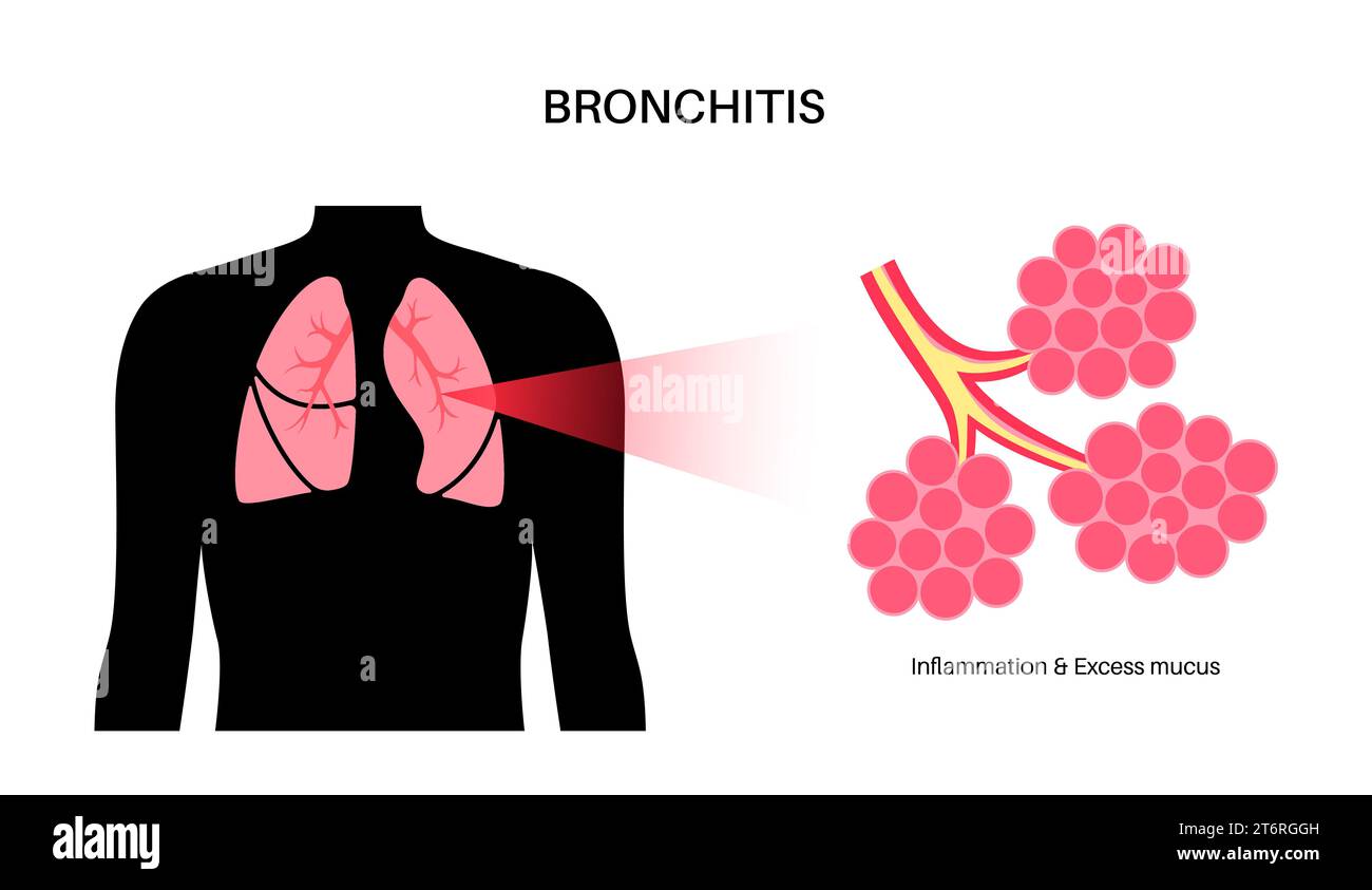 Bronchitis lung disease, illustration Stock Photo - Alamy