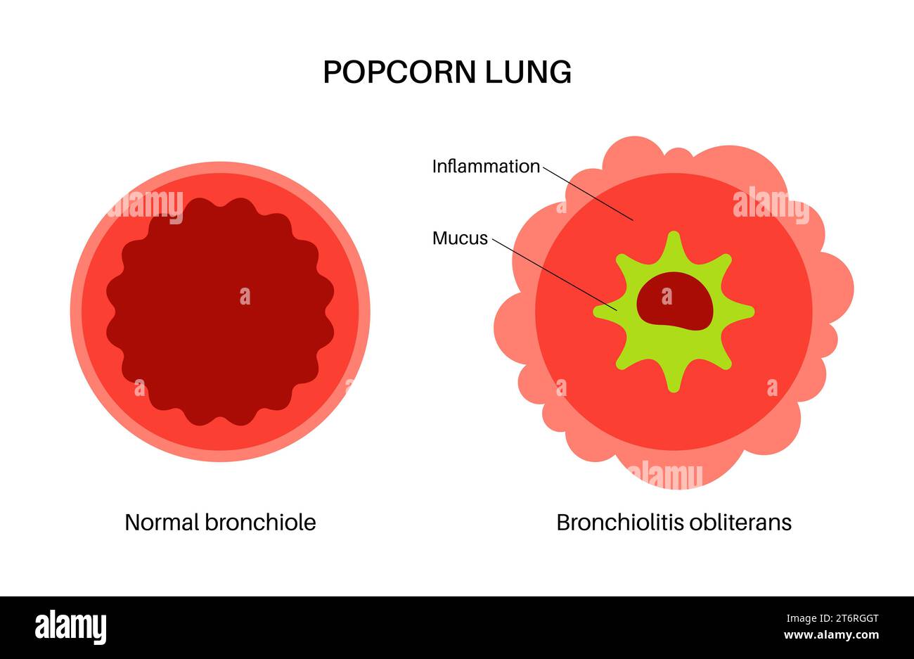 Popcorn Lung Symptoms Skin Rash At Joyce Sargent Blog