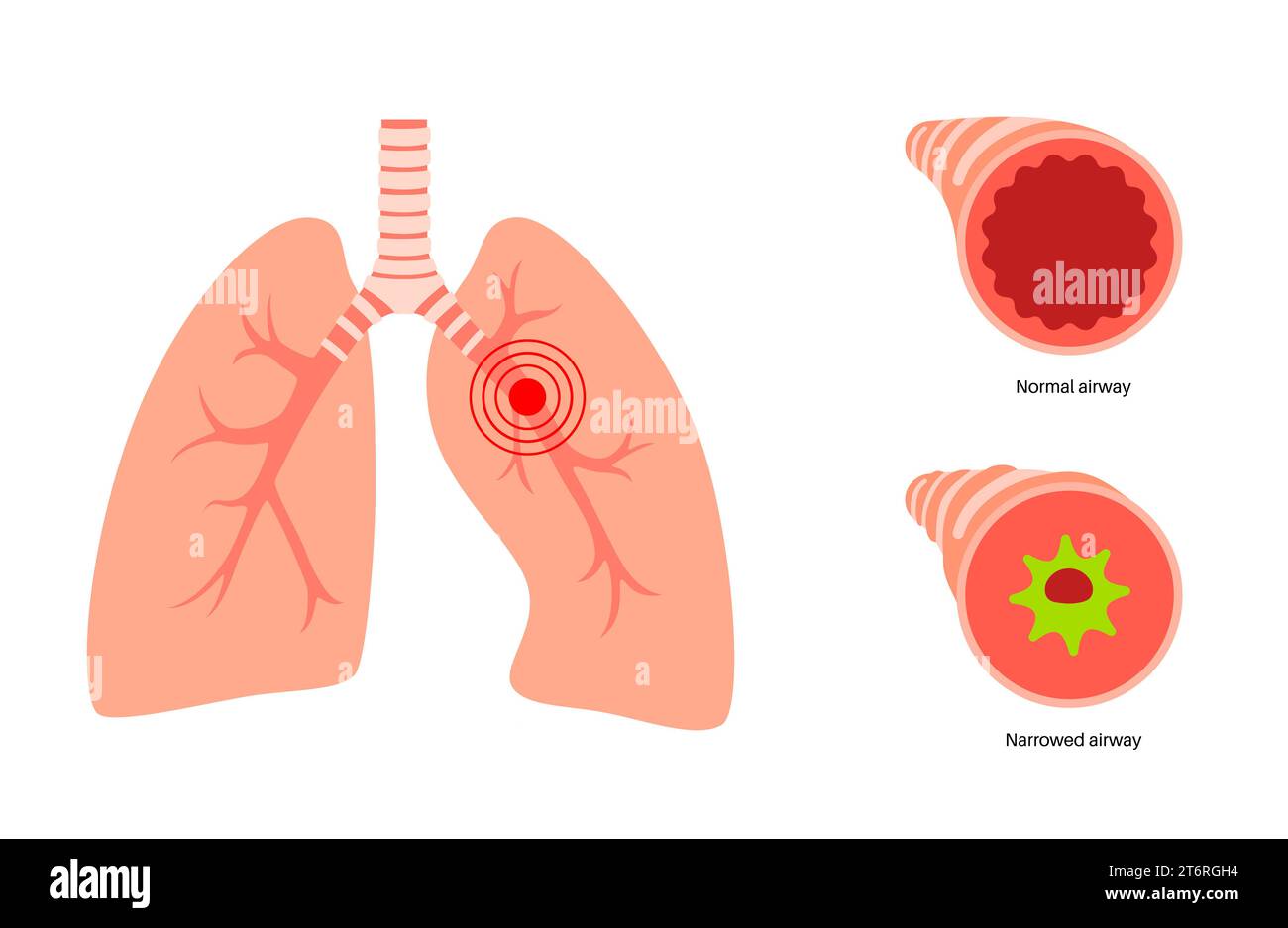 Bronke Bronchitis lung disease, illustration Stock Photo - Alamy