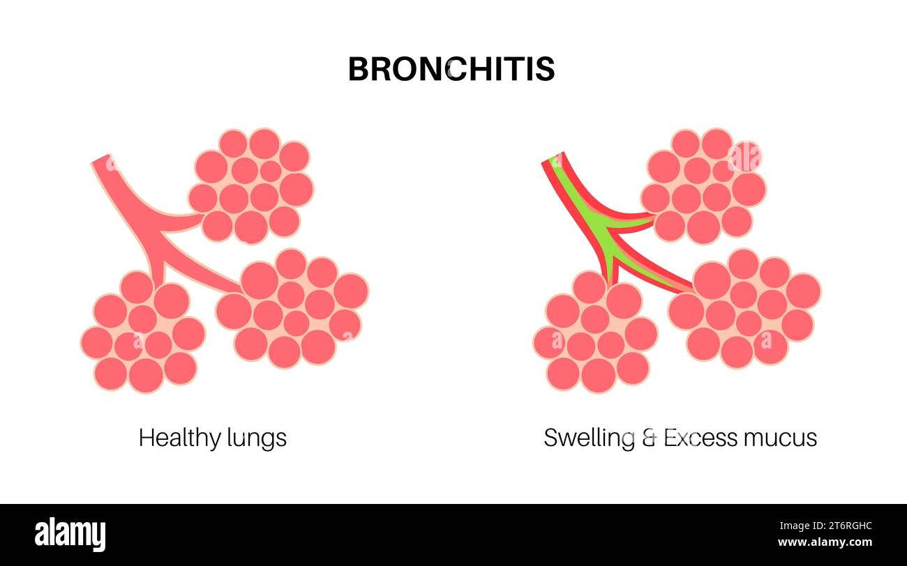 Bronke Bronchitis lung disease, illustration Stock Photo - Alamy