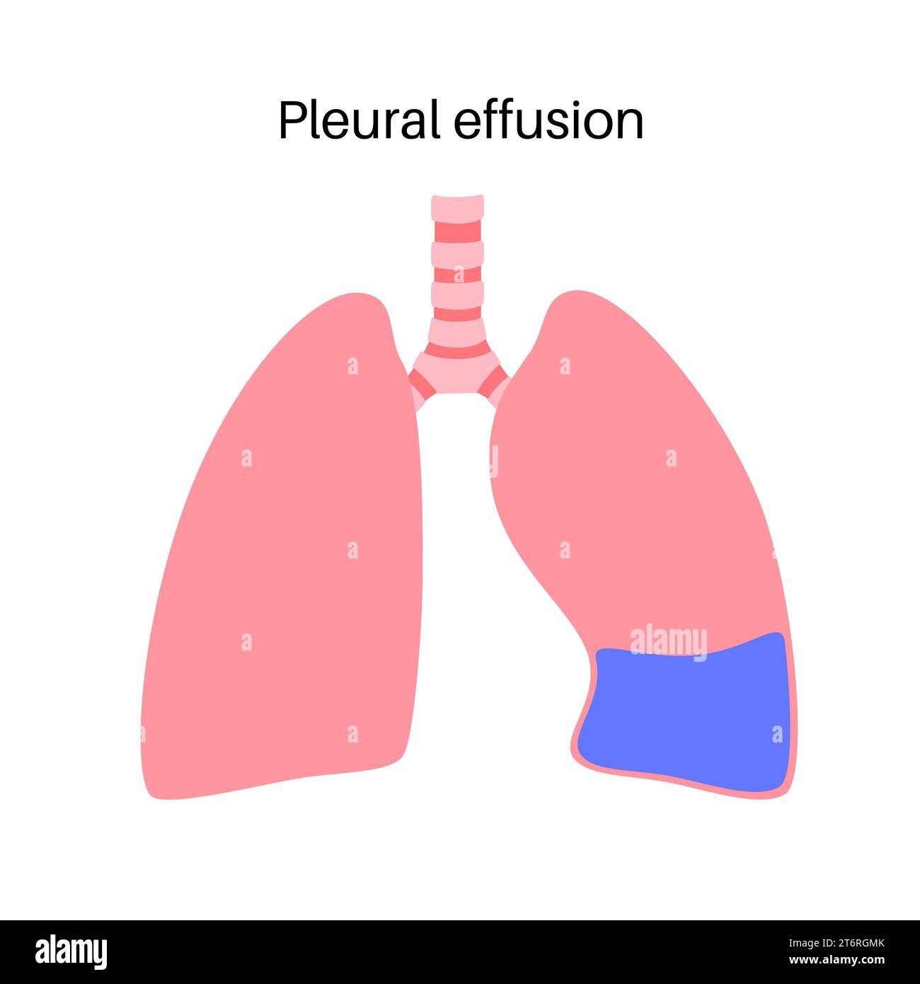 Pleural effusion, illustration Stock Photo Alamy