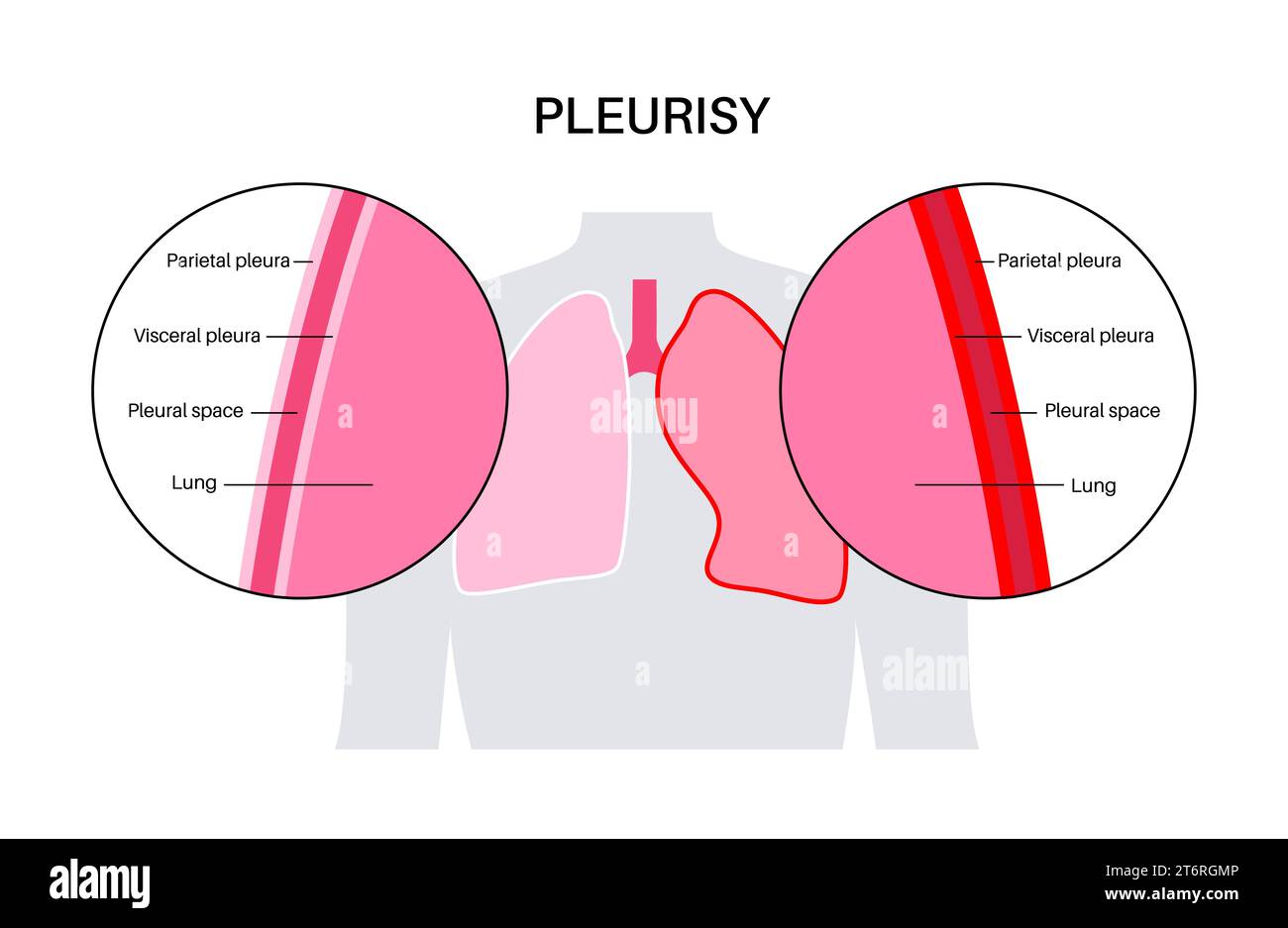Pleurisy, illustration Stock Photo