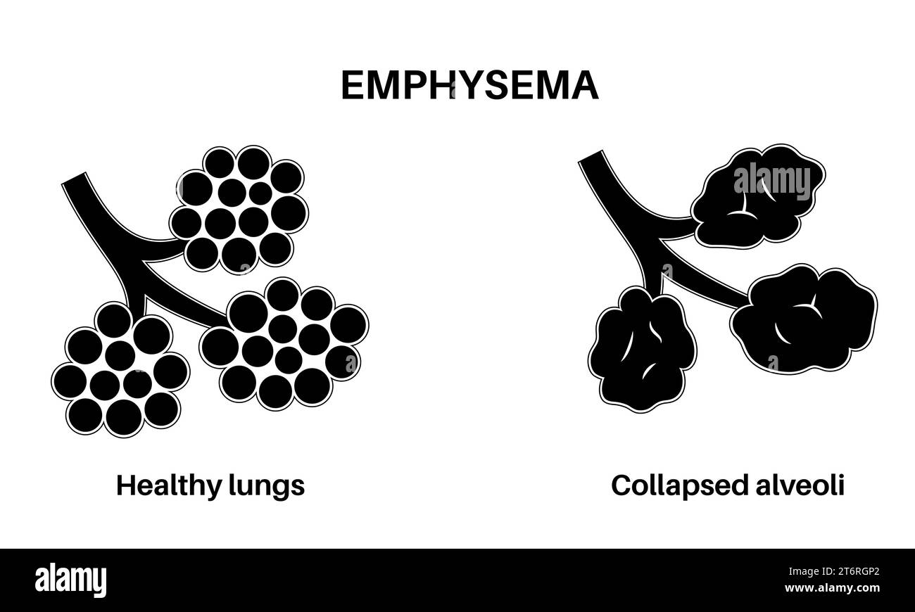 Emphysema, illustration Stock Photo