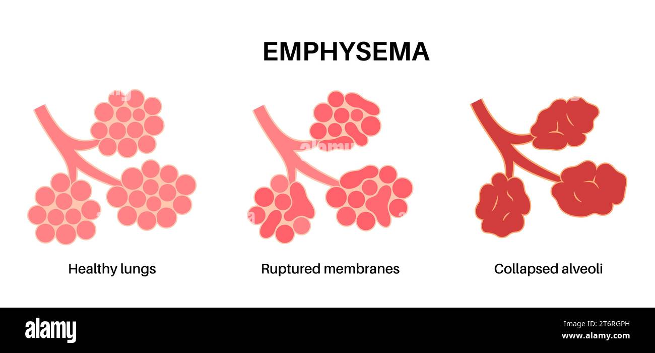 Emphysema, illustration Stock Photo