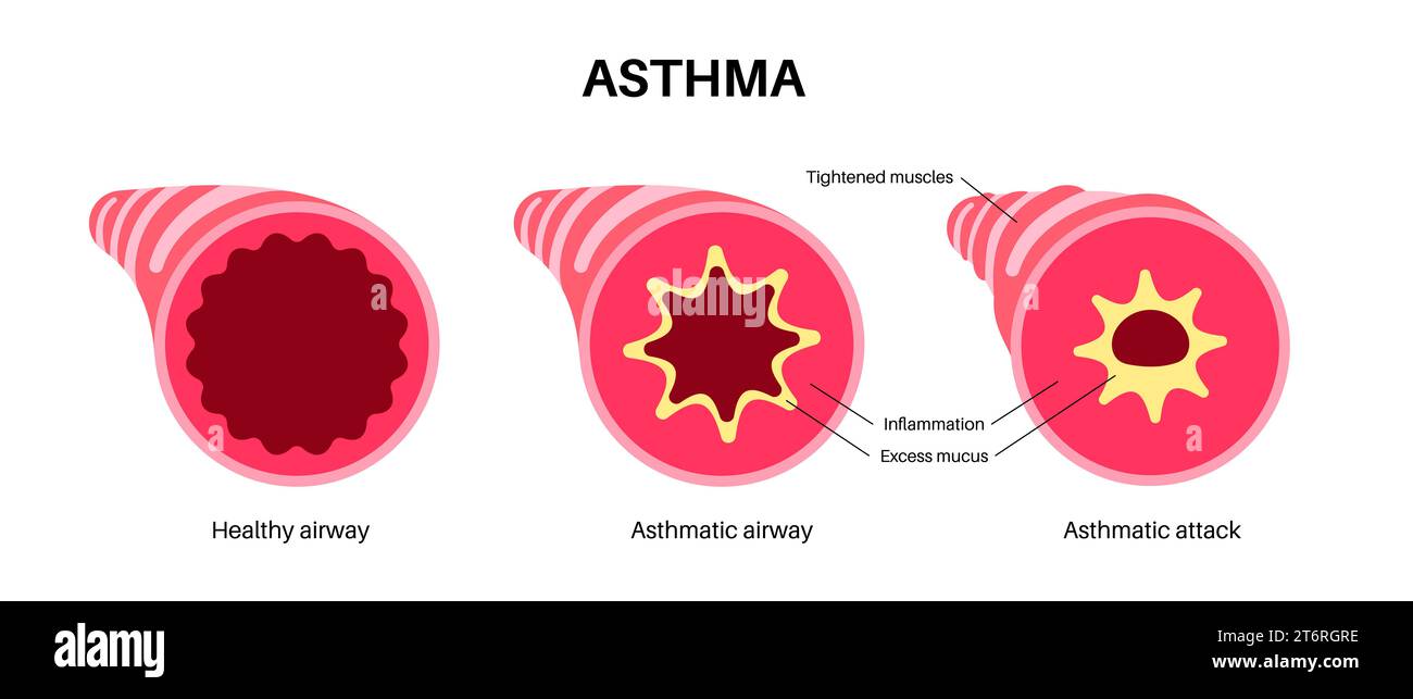 Bronchiole asthma hires stock photography and images Alamy