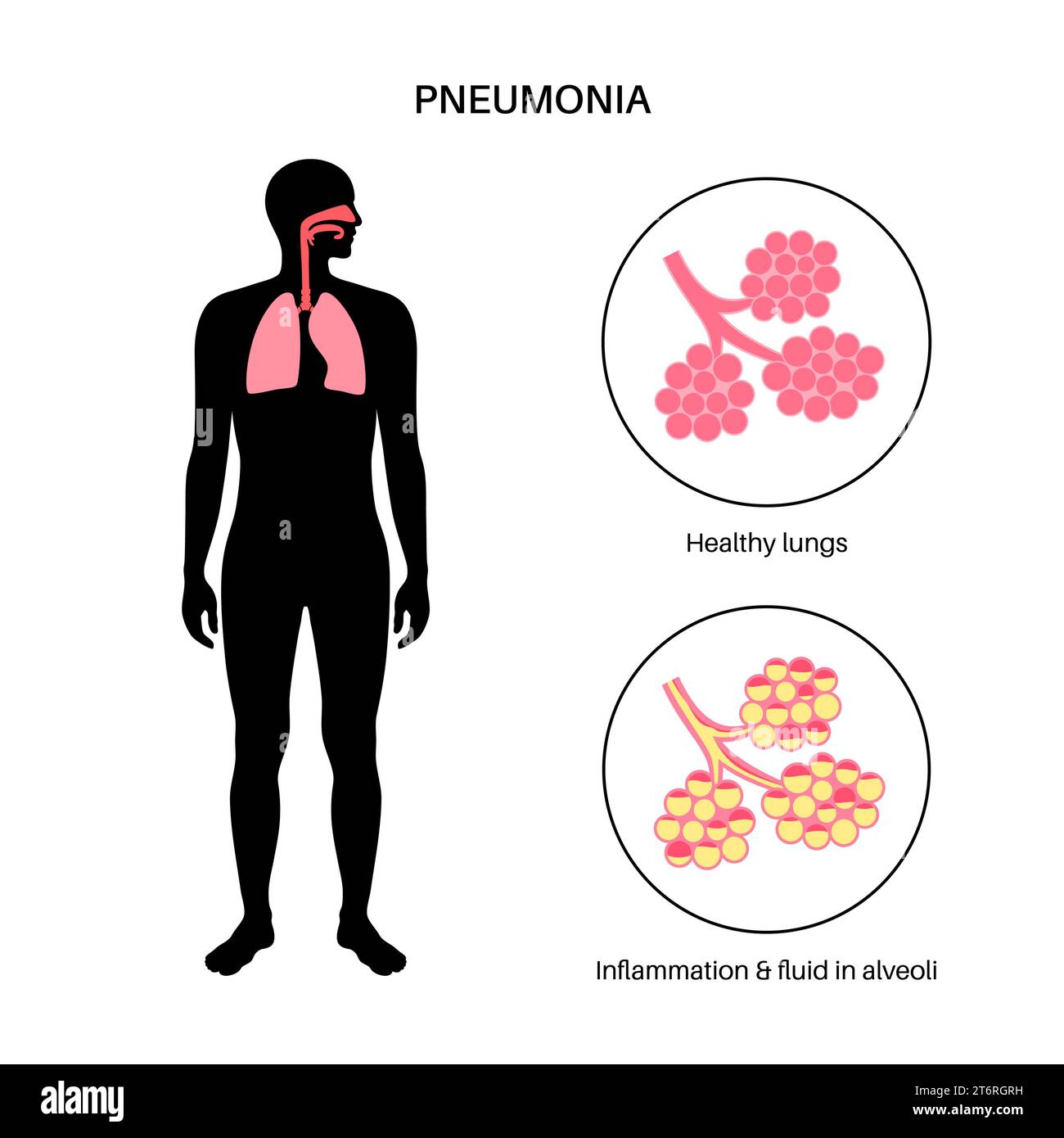 Pneumonia alveolus Cut Out Stock Images & Pictures - Alamy