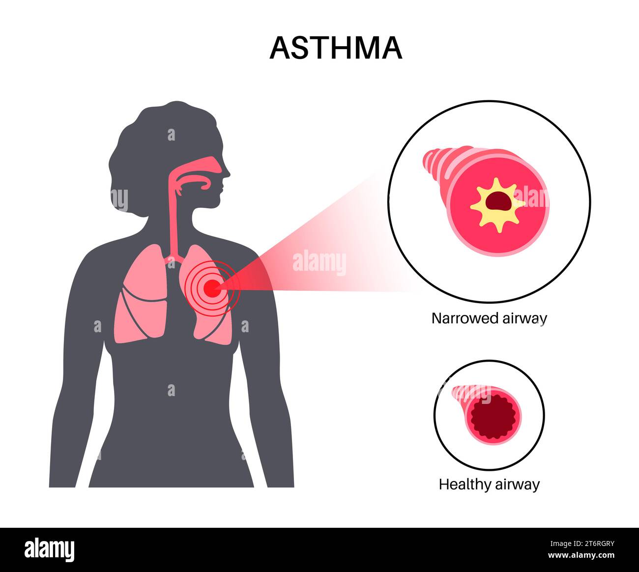 Asthma, illustration Stock Photo