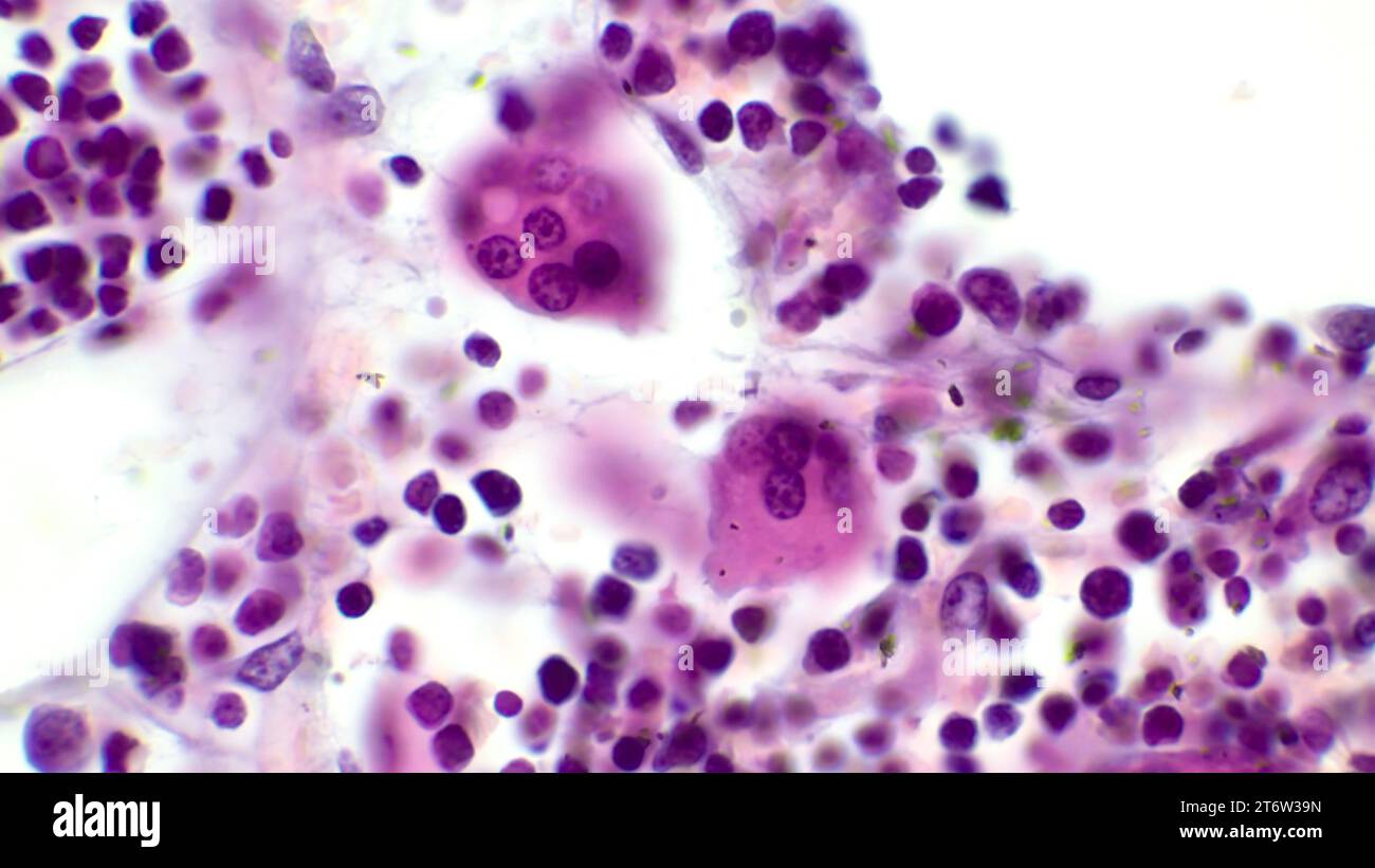 Osteoclasts. Two osteoclasts in red bone marrow. Hematoxylin and eosin staining. Magnification - 1000. Stock Photo