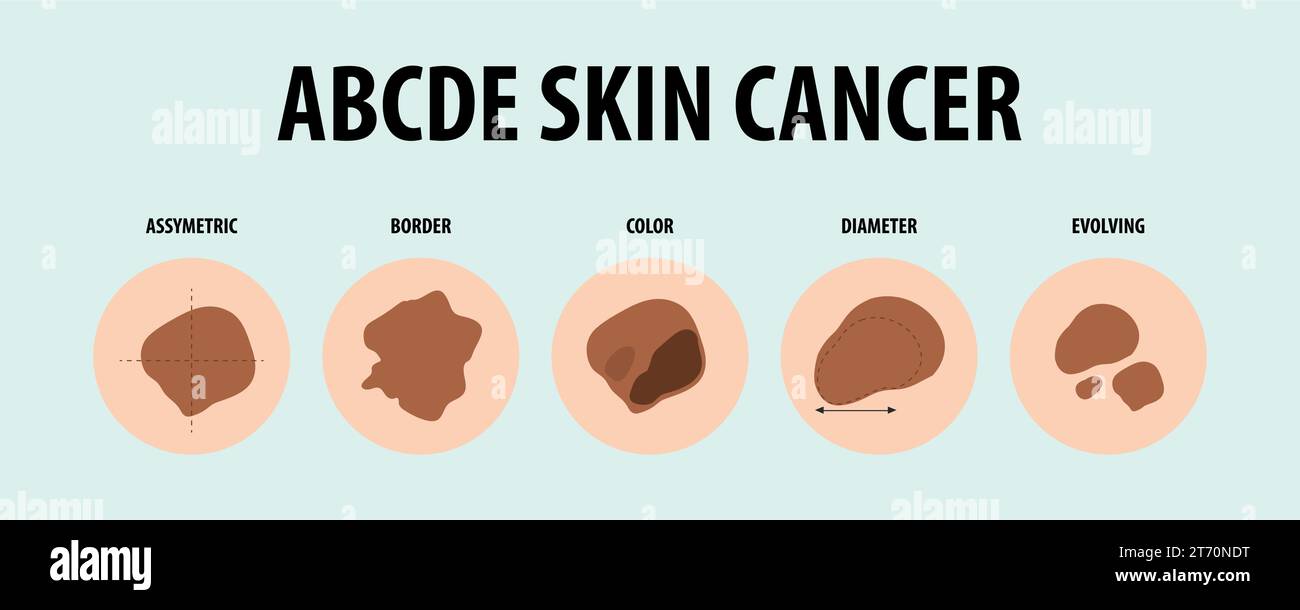 Learn about different types of skin cancer through vector illustrations