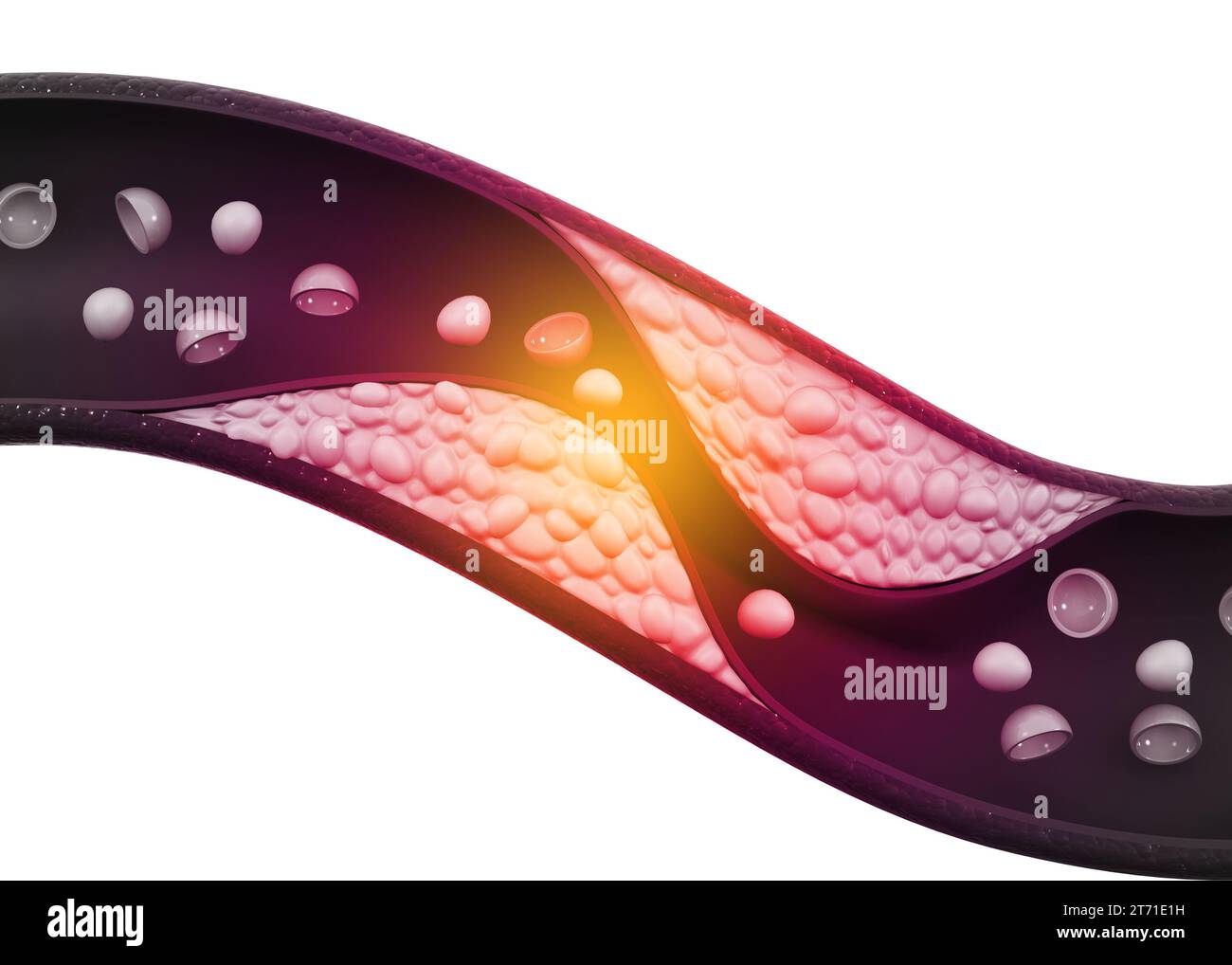 Cholesterol plaque in arteries. 3d illustration Stock Photo Alamy