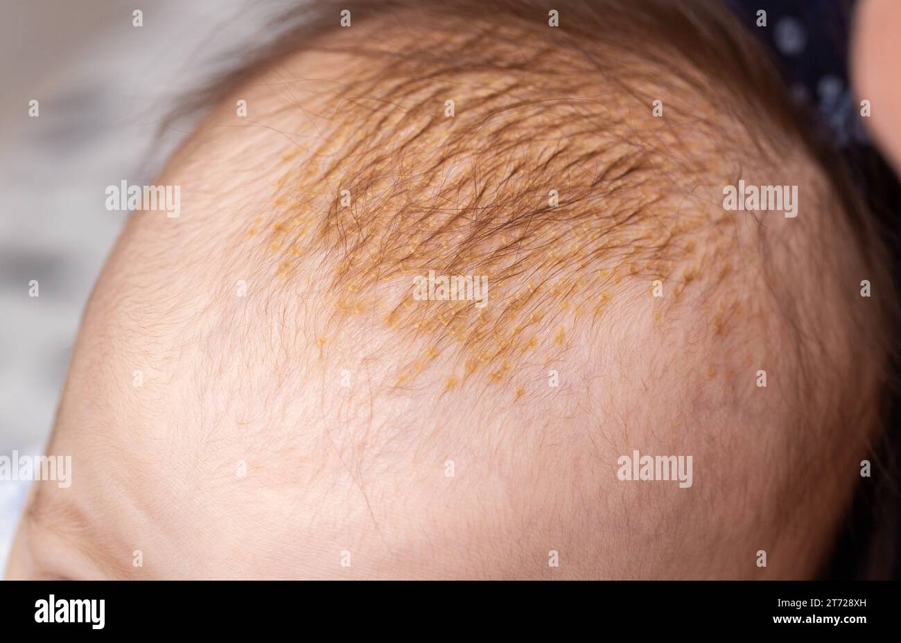 the process of formation of seborrheic dermatitis in an infant on the