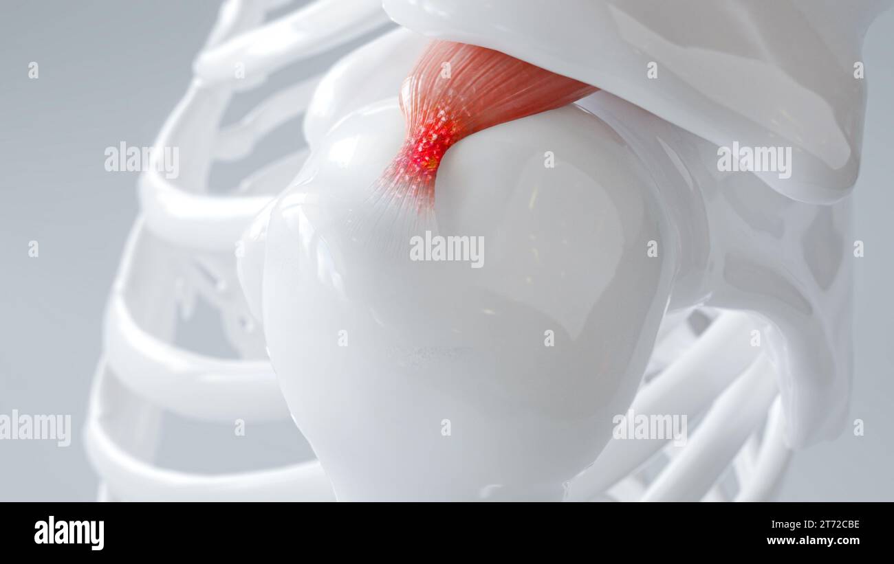 Inflamed Rotator Cuff in Shoulder Joint - A 3D Render Stock Photo