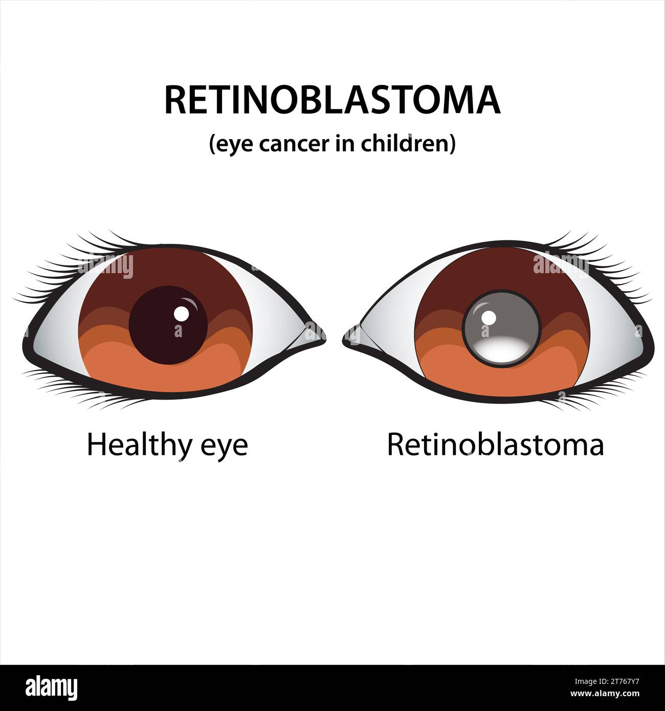 Retinoblastoma Eye cancer in children illustration Stock Photo