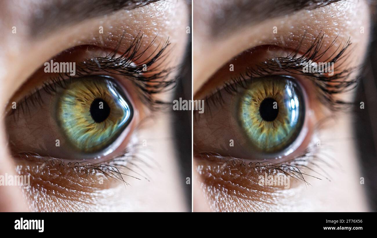 Macro before and after surgery of a clear female eye of a Caucasian woman suffering from keratoconus. A cone-shaped deformation of the cornea Stock Photo