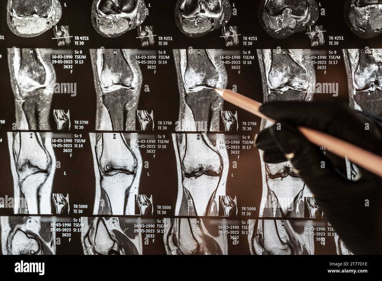 Magnetic resonance imaging of human knee joint for medical diagnosis ...