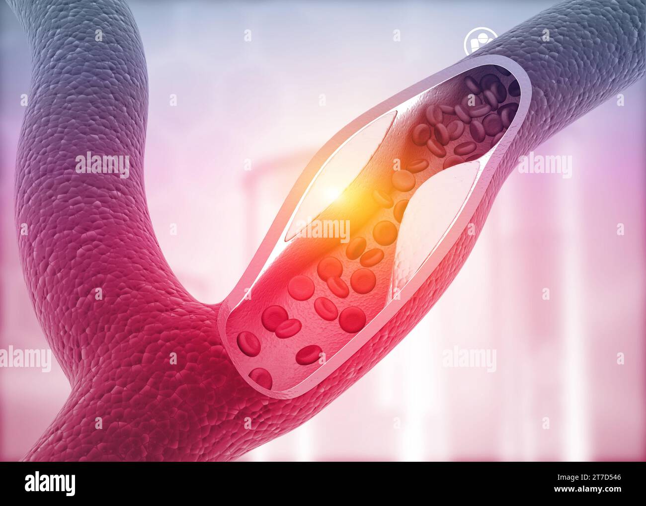 Atherosclerosis, Cholesterol plaque in artery. 3d illustration Stock