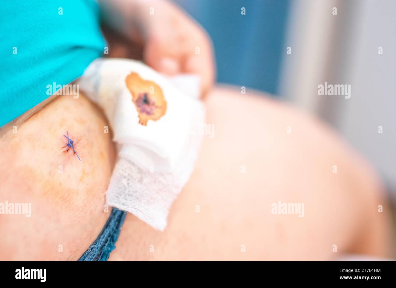 Hip and leg with wound and stitches with one hand removing dirty gauze Stock Photo