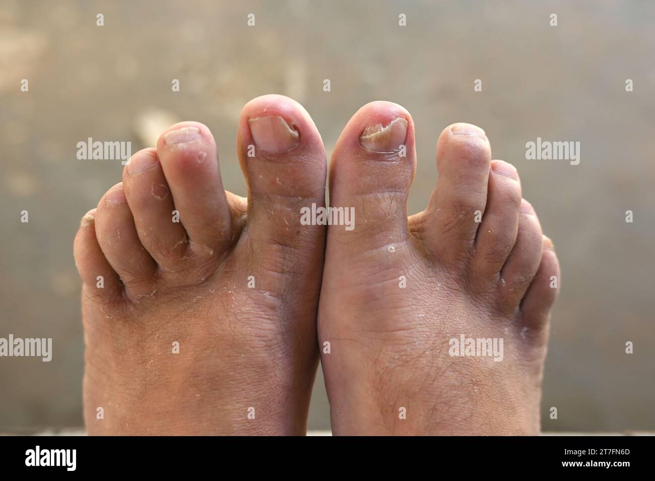 ringworm Fungal infection of the nails on the big toe. Fungal infection