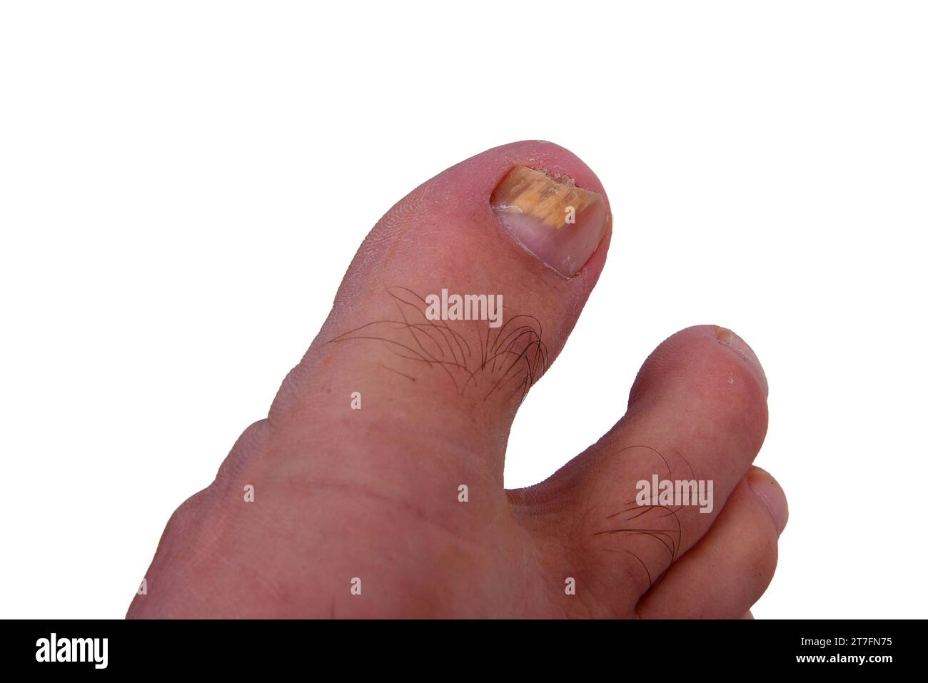 Nail fungus infection on big toe. Fungal infection on fingernails toe with ringworm onychomycosis, disease result Stock Photo