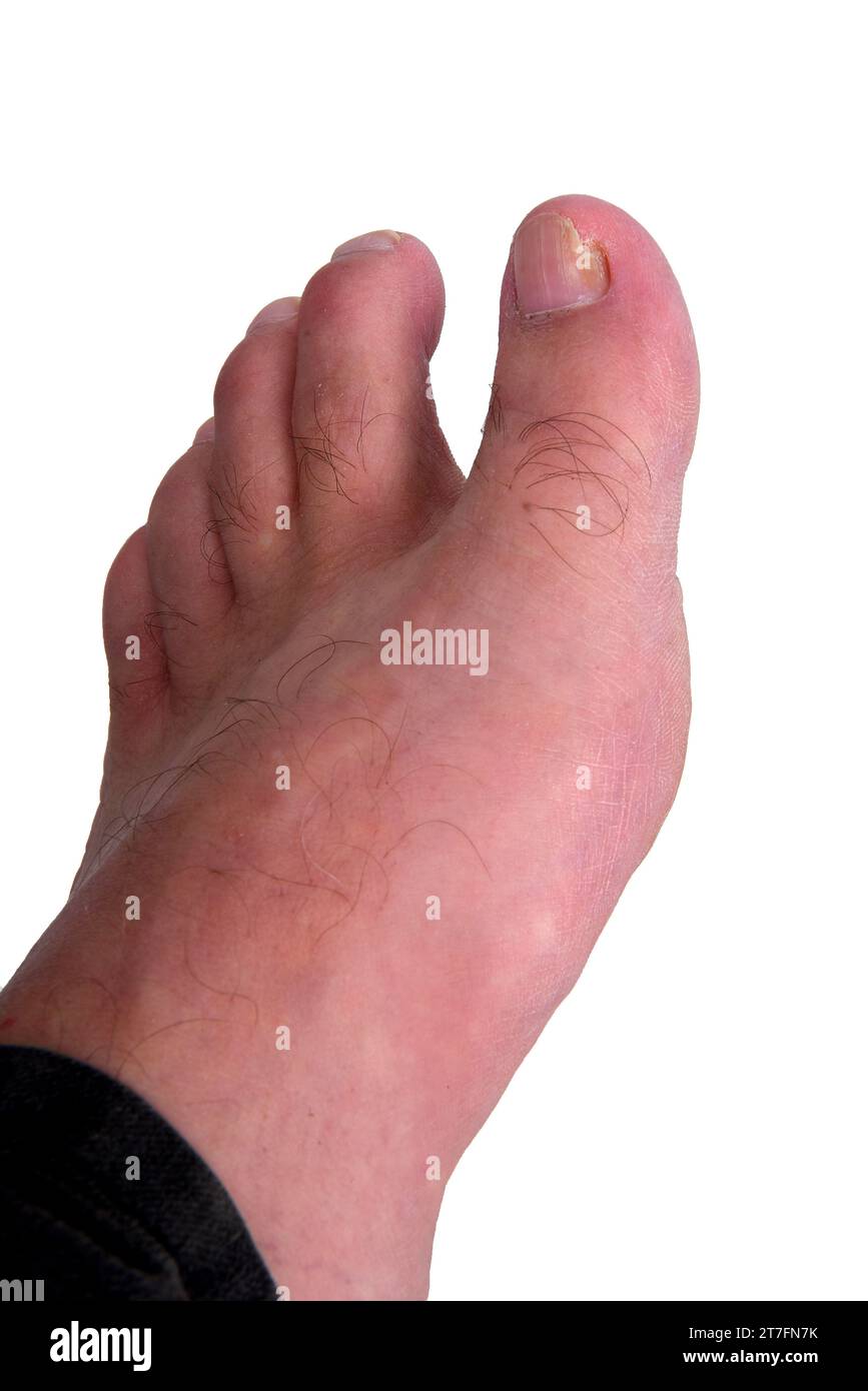 Nail fungus infection on big toe. Fungal infection on fingernails toe with ringworm onychomycosis, disease result Stock Photo