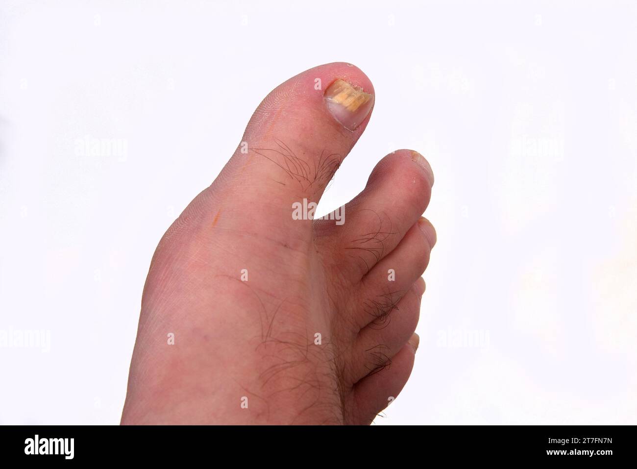 micose Nail fungus infection on big toe. Fungal infection on fingernails toe with ringworm onychomycosis, disease result Stock Photo