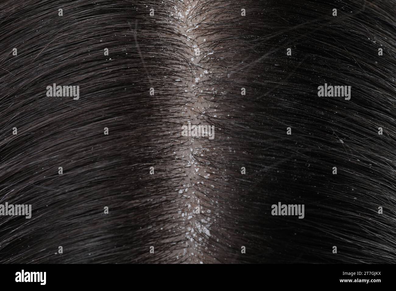 Hair with dandruff hi-res stock photography and images - Alamy