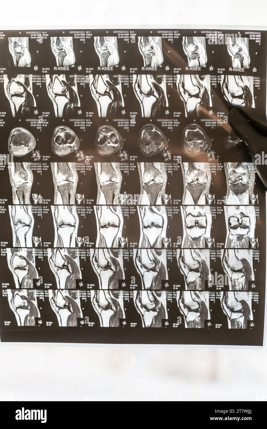 Magnetic resonance imaging of human knee joint for medical diagnosis ...