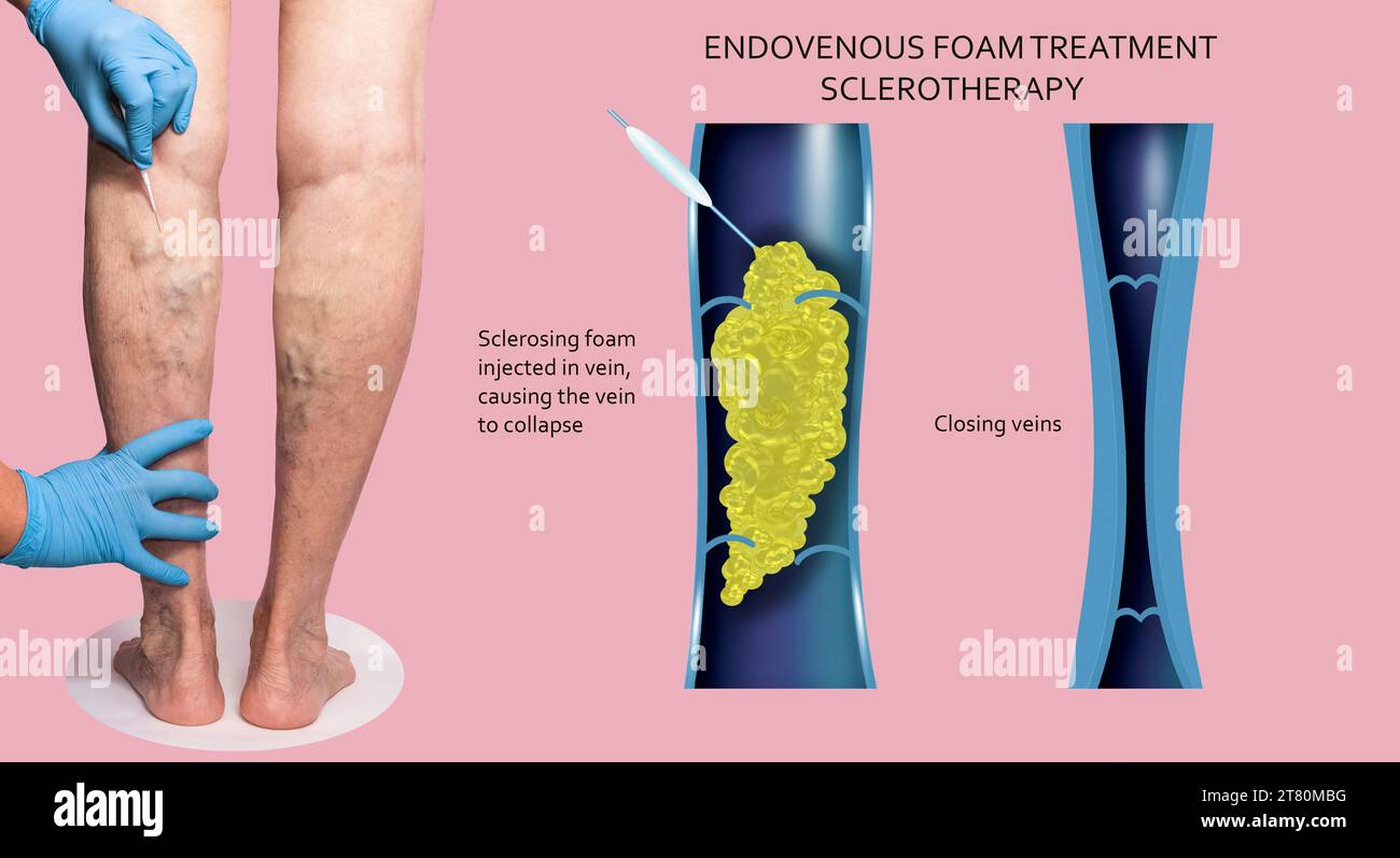 Endovenous laser treatment for varicose veins foam sclerotherapy