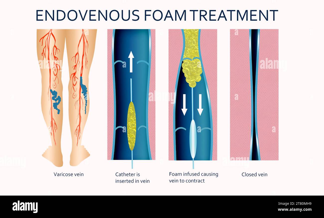 Varicose Veins. Endovenous foam Treatment. When injected inside a vein